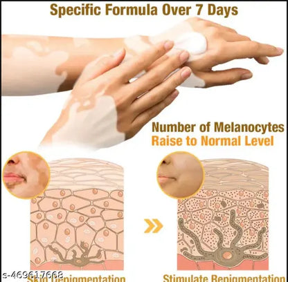 Bee Venom Vitigo Correcting Cream - (Pack of 2)