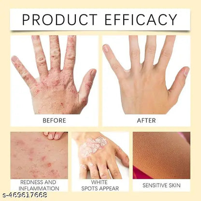 Bee Venom Vitigo Correcting Cream - (Pack of 2)